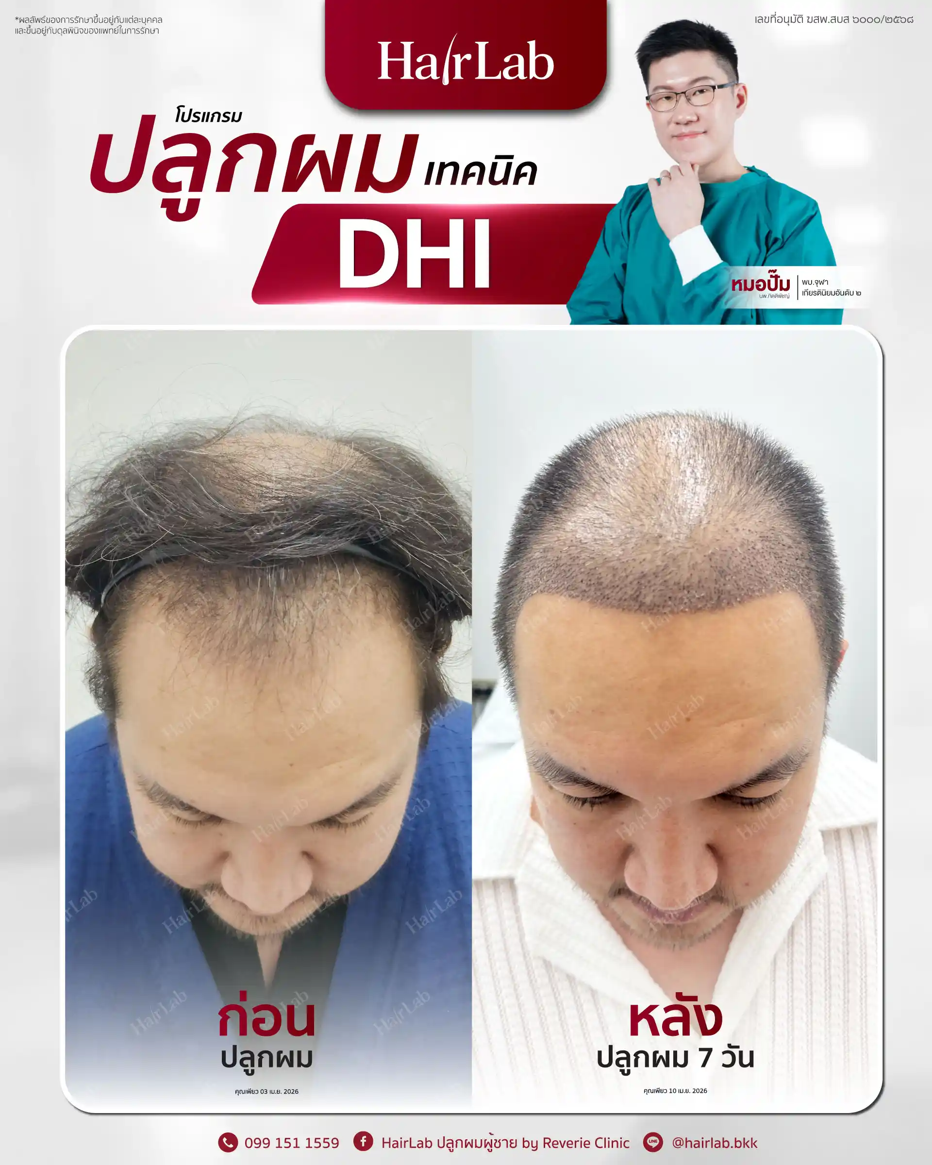 ก่อน-หลังปลูกผมเทคนิค DHI-15