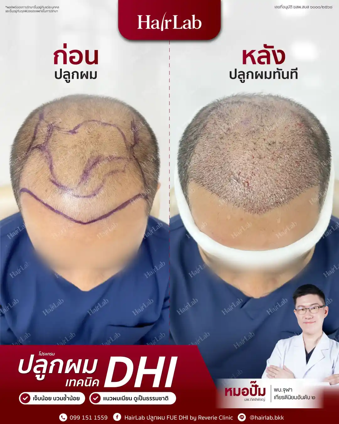 ก่อน-หลังปลูกผมเทคนิค DHI-01