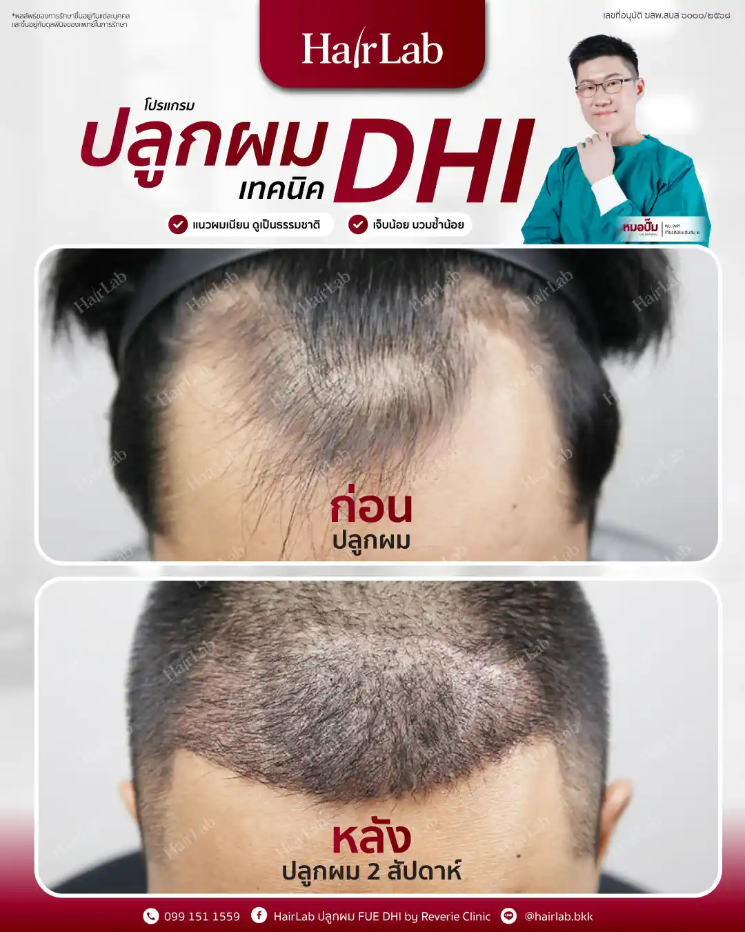 ก่อน-หลังปลูกผมเทคนิค DHI-10
