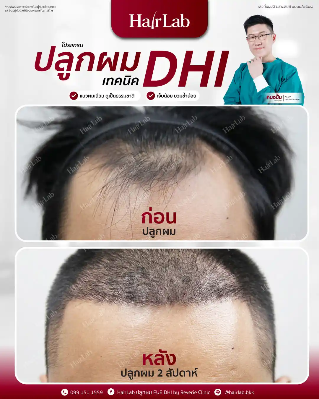 ก่อน-หลังปลูกผมเทคนิค DHI-11
