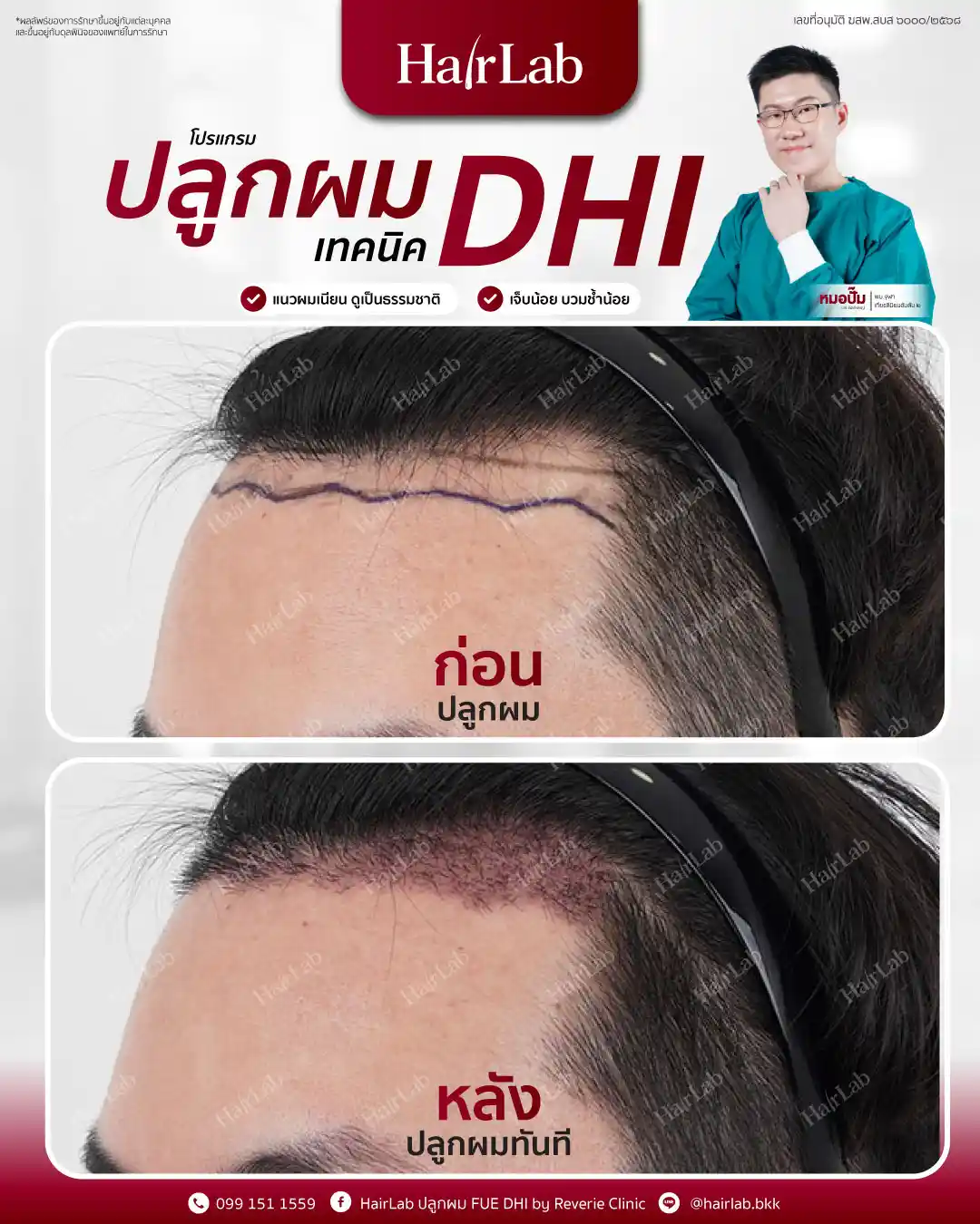 ก่อน-หลังปลูกผมเทคนิค DHI-14