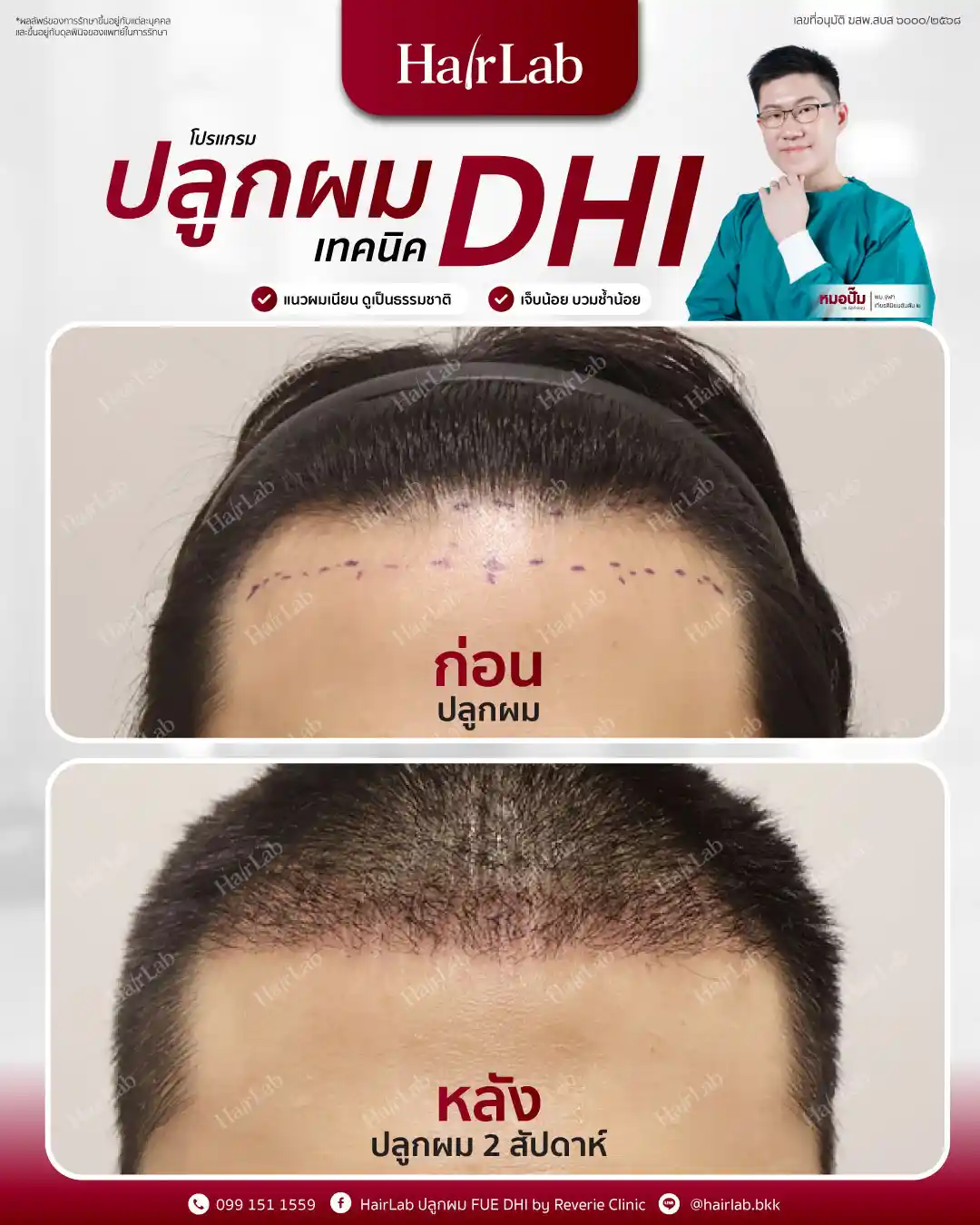ก่อน-หลังปลูกผมเทคนิค DHI-15