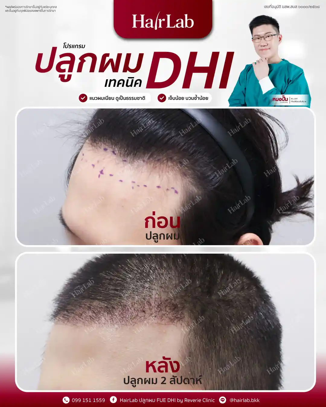 ก่อน-หลังปลูกผมเทคนิค DHI-16