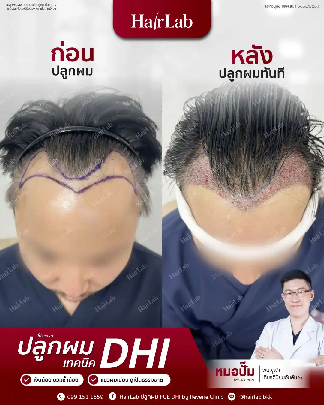 ก่อน-หลังปลูกผมเทคนิค DHI-02
