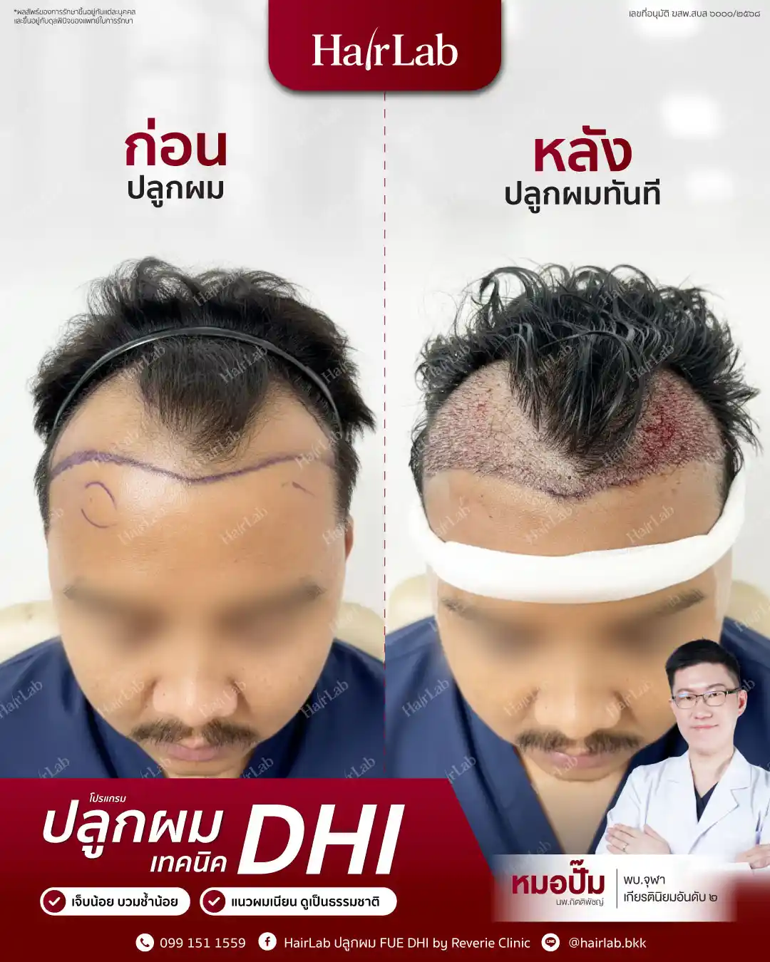 ก่อน-หลังปลูกผมเทคนิค DHI-03