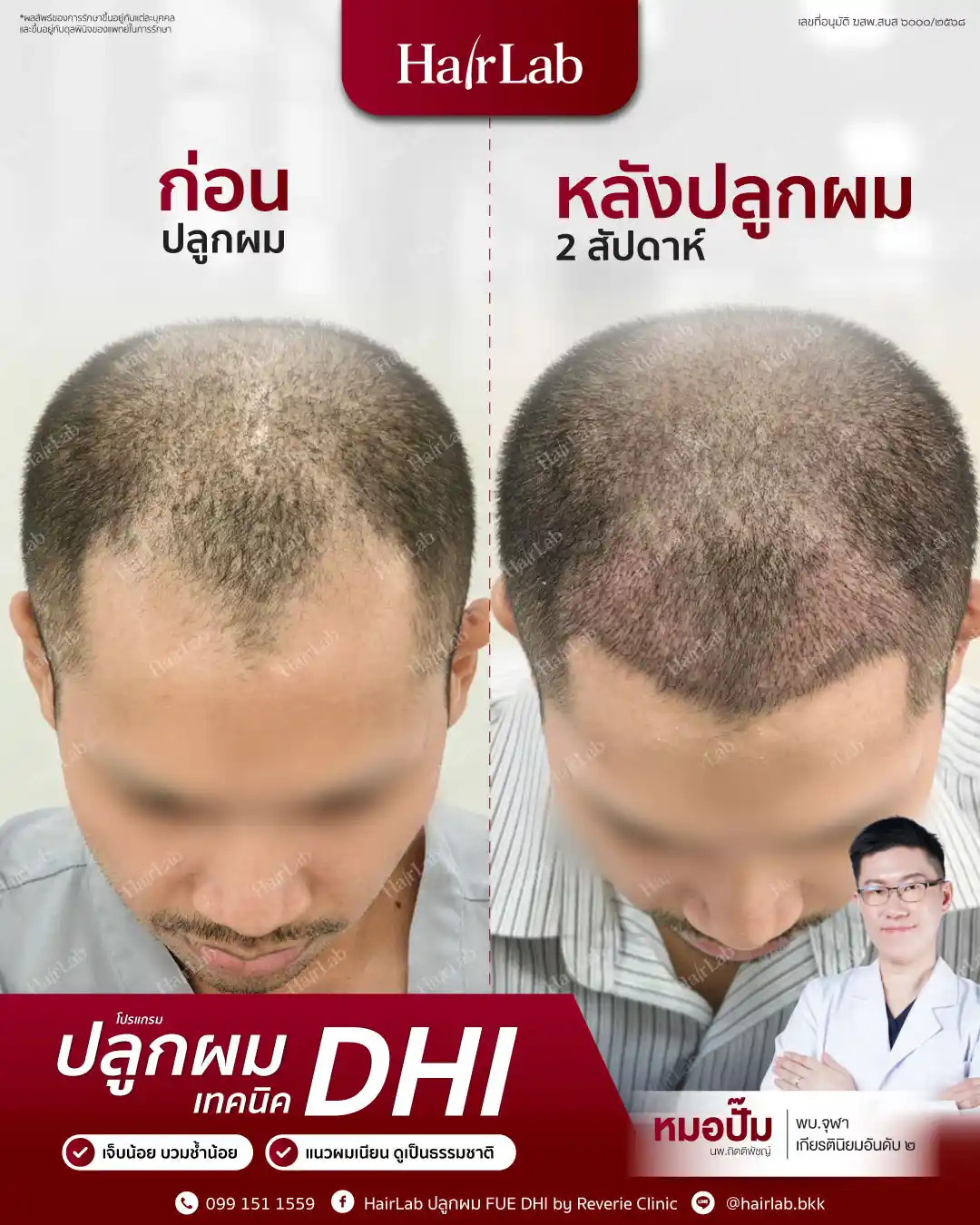 ก่อน-หลังปลูกผมเทคนิค DHI-04