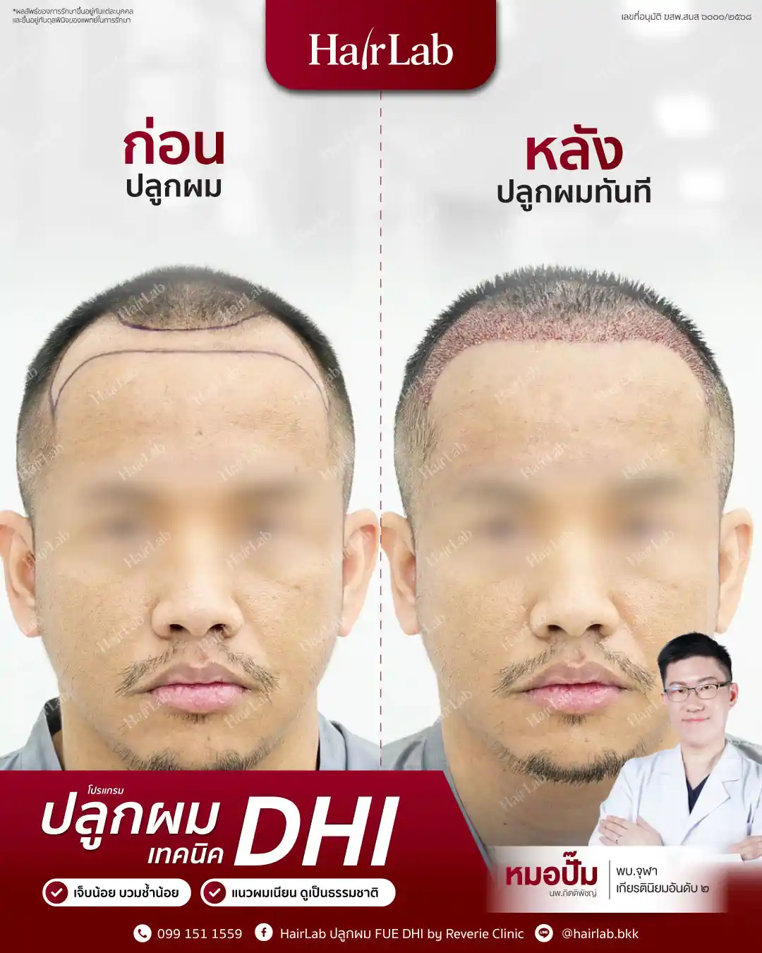 ก่อน-หลังปลูกผมเทคนิค DHI-05