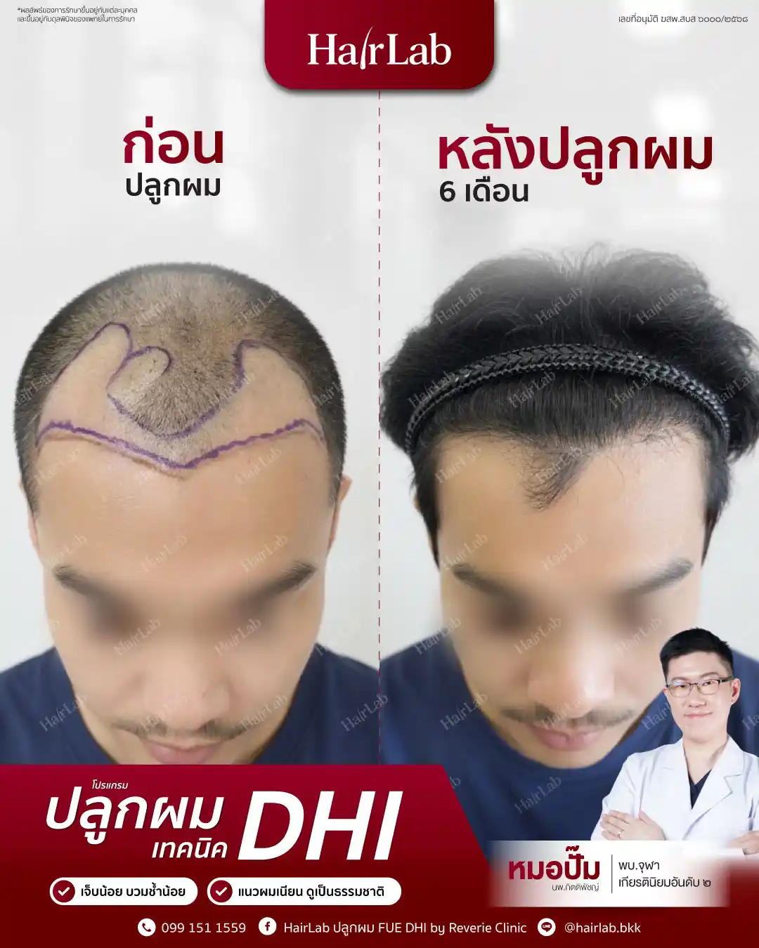 ก่อน-หลังปลูกผมเทคนิค DHI-06