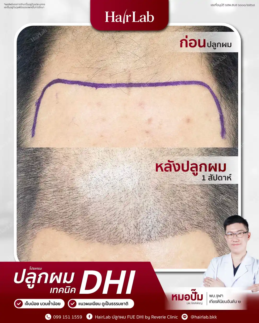 ก่อน-หลังปลูกผมเทคนิค DHI-07