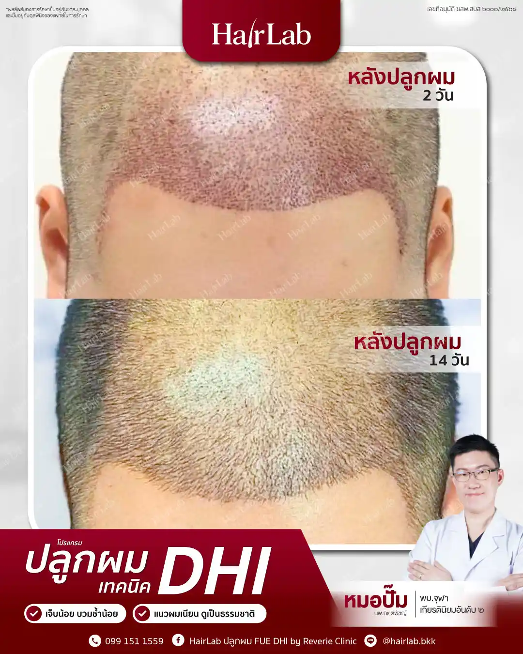 ก่อน-หลังปลูกผมเทคนิค DHI-08