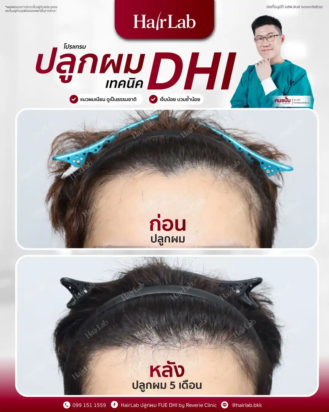 ก่อน-หลังปลูกผมเทคนิค DHI-09