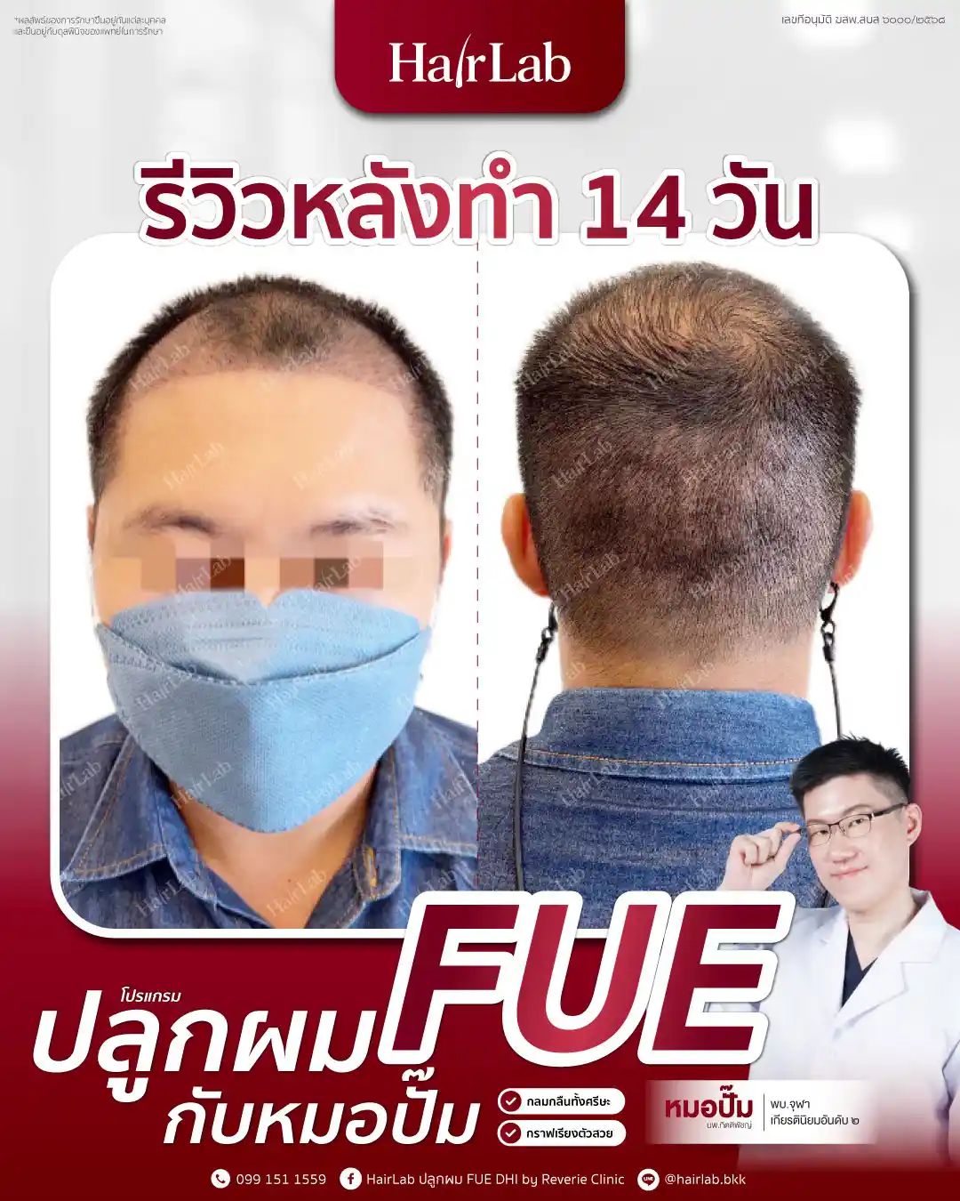 ก่อน-หลังปลูกผมเทคนิค FUE-01