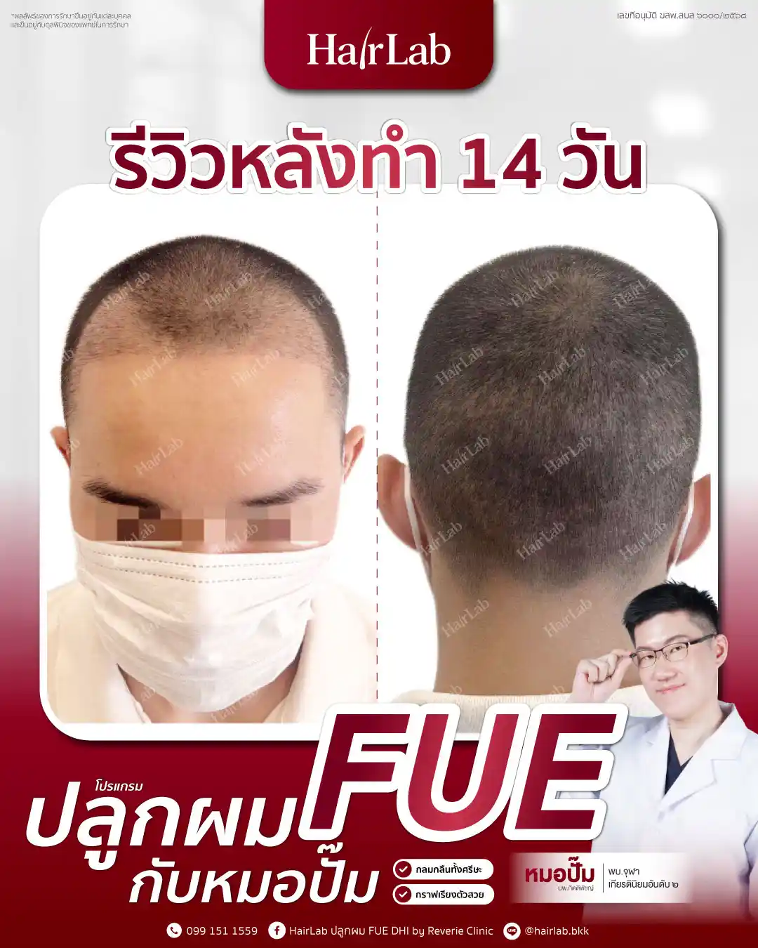 ก่อน-หลังปลูกผมเทคนิค FUE-03