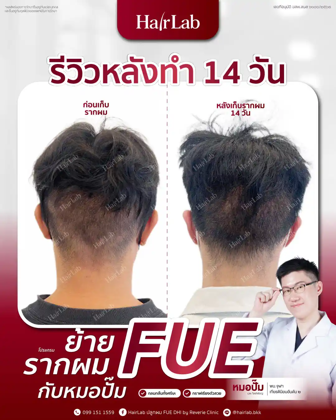 ก่อน-หลังปลูกผมเทคนิค FUE-04