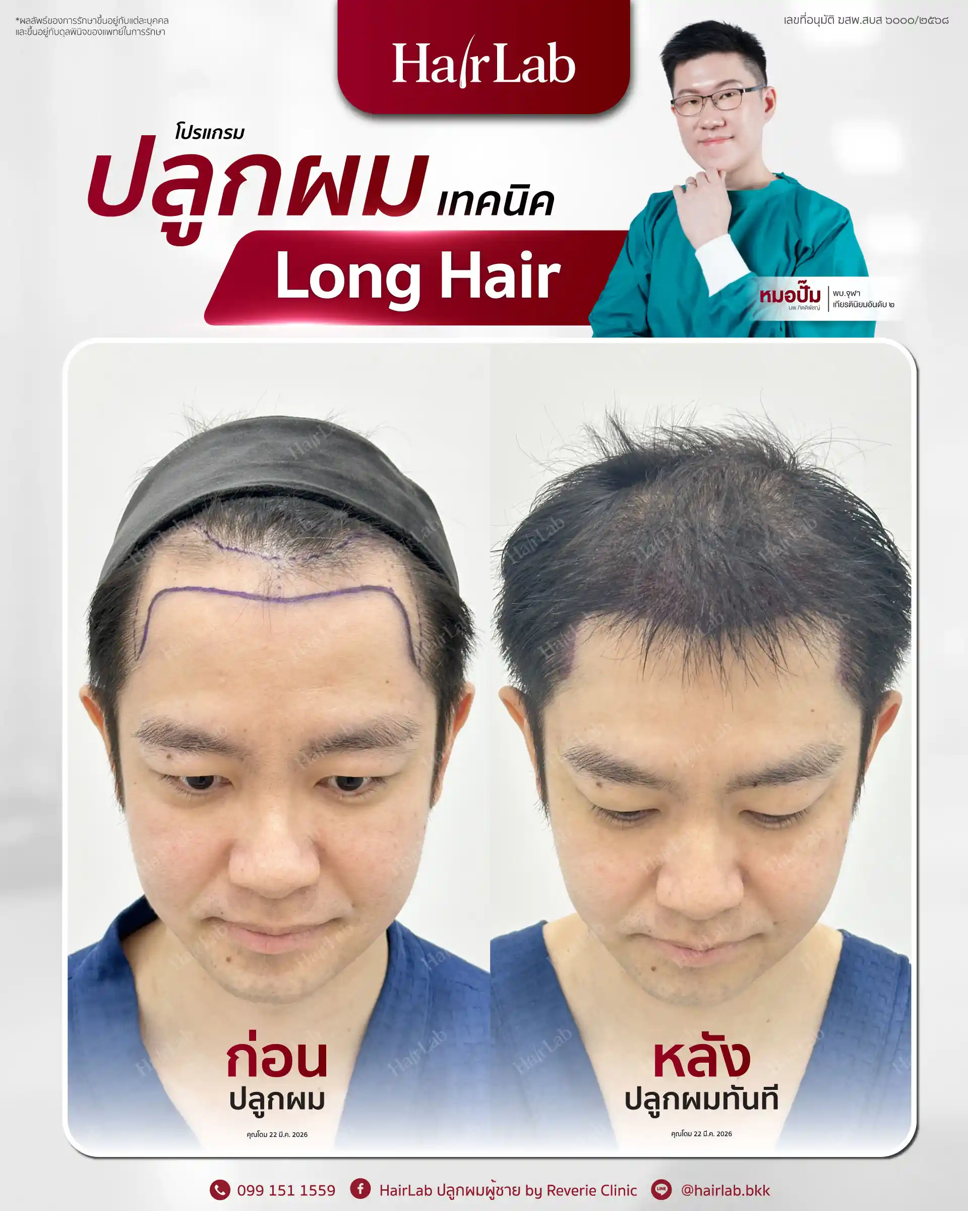 ก่อน-หลังปลูกผมเทคนิค Long Hair-01