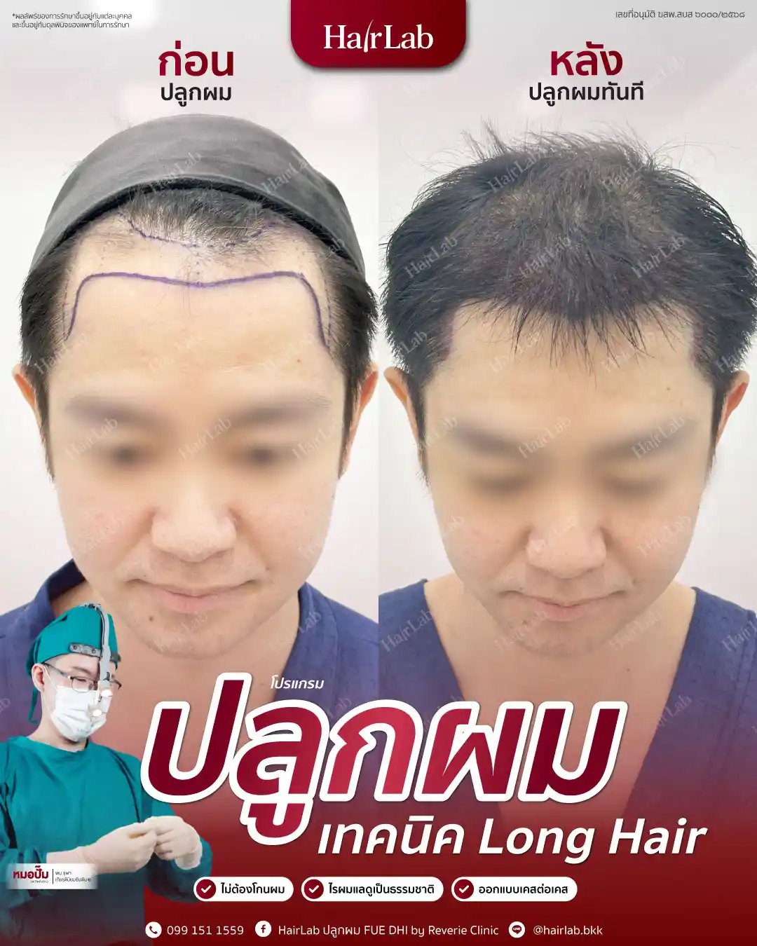 ก่อน-หลังปลูกผมเทคนิค Long Hair-02