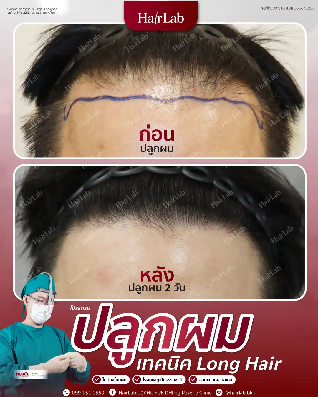 ก่อน-หลังปลูกผมเทคนิค Long Hair-03