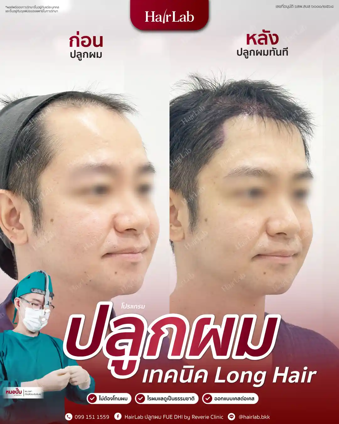 ก่อน-หลังปลูกผมเทคนิค Long Hair-04