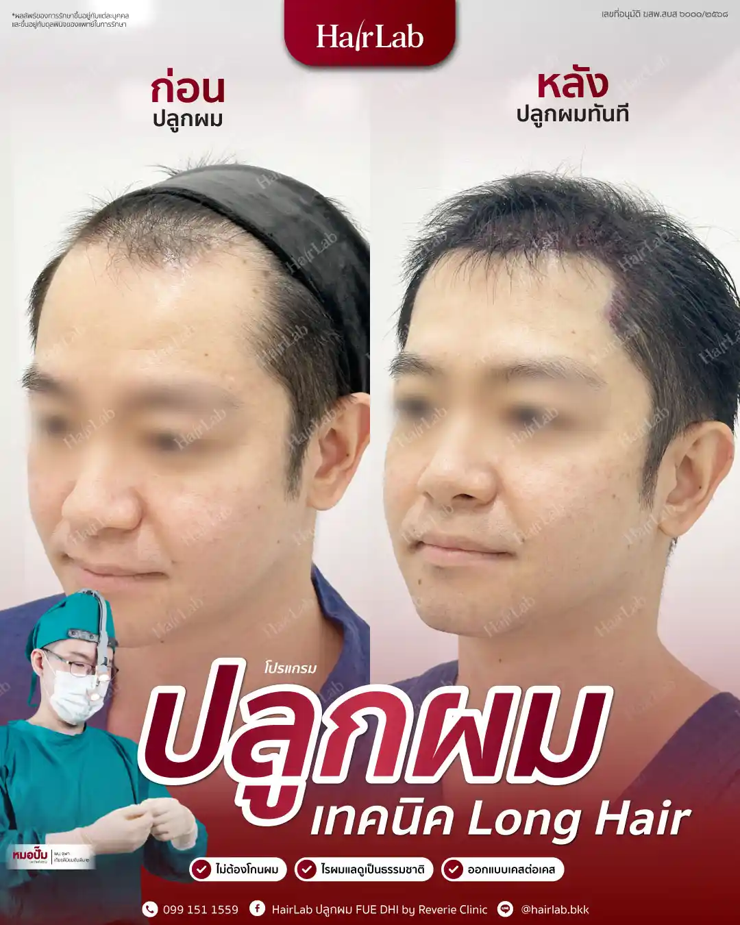 ก่อน-หลังปลูกผมเทคนิค Long Hair-05