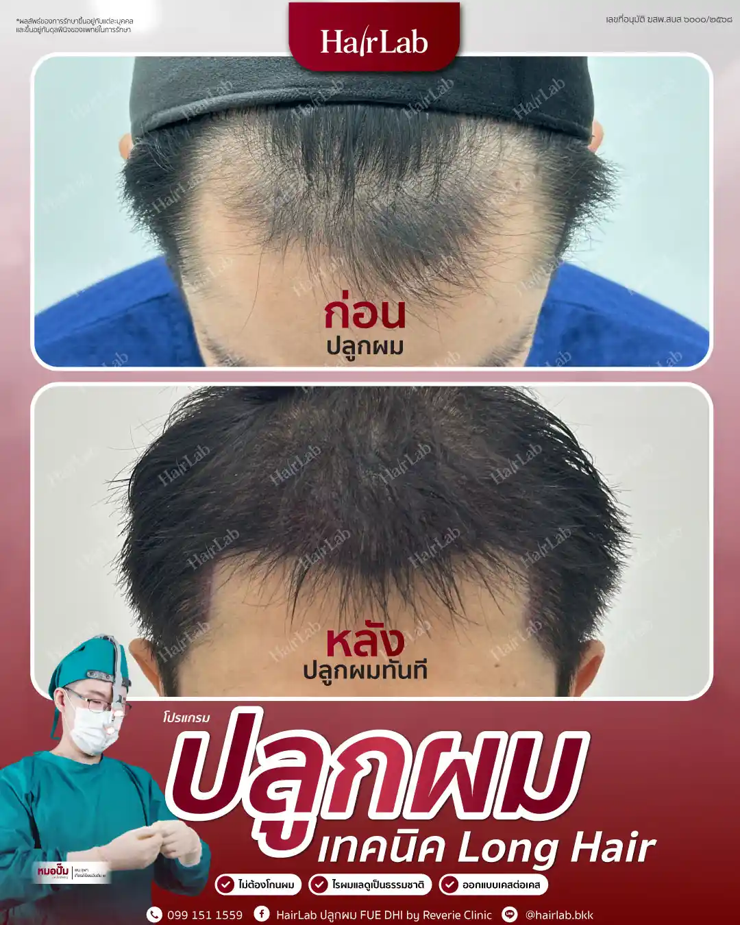 ก่อน-หลังปลูกผมเทคนิค Long Hair-06