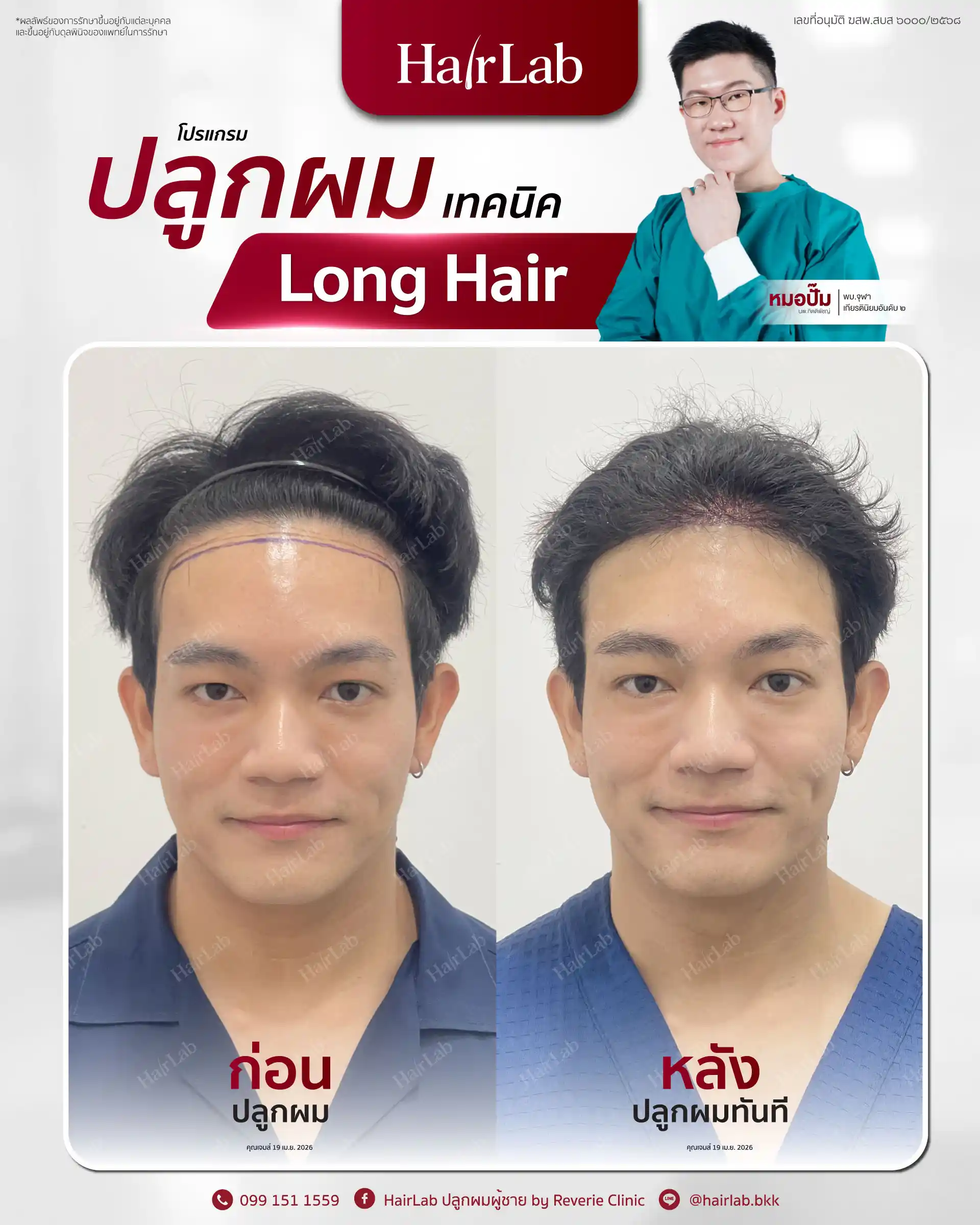 ก่อน-หลังปลูกผมเทคนิค Long Hair-07