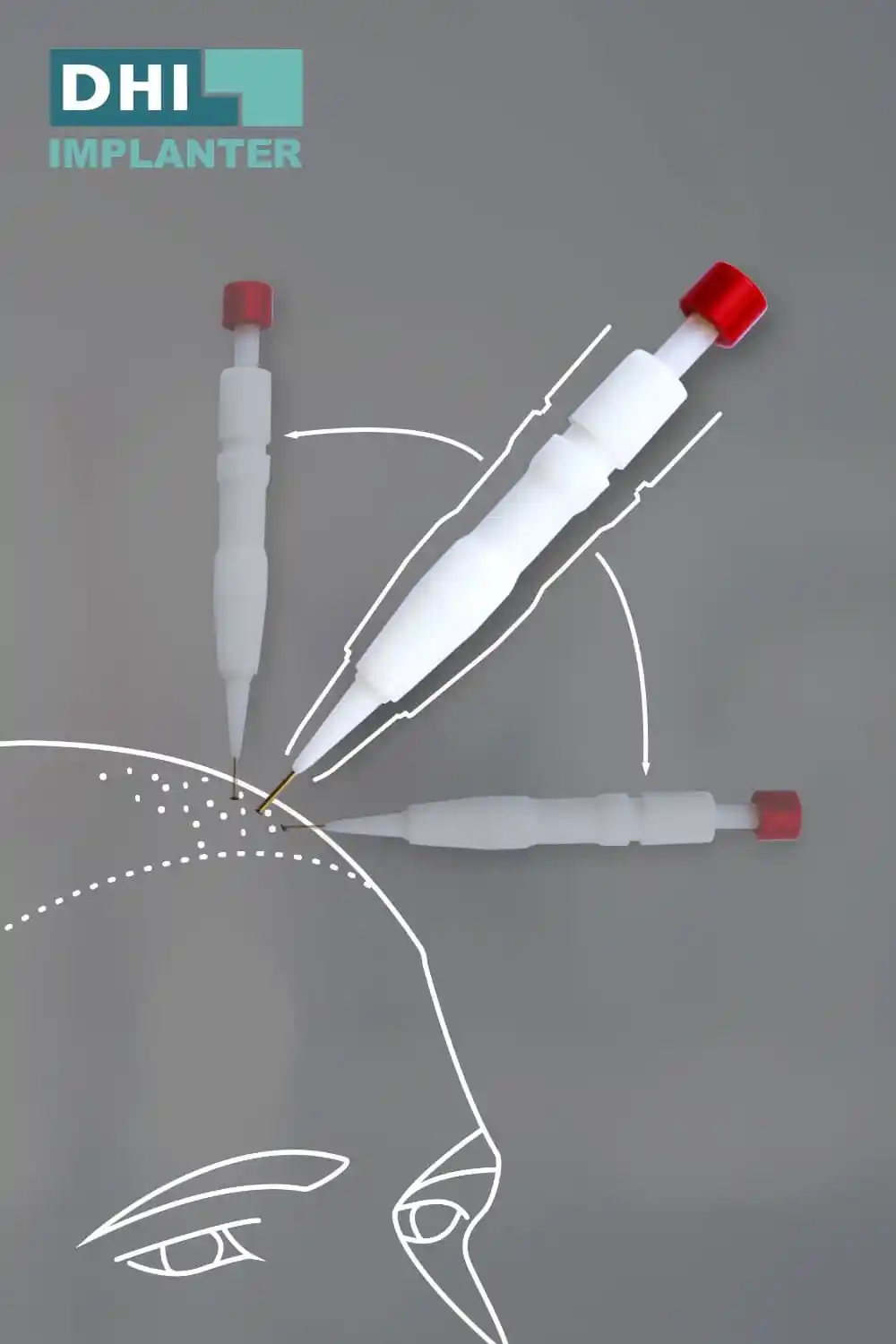 เครื่องปลูกถ่ายเส้นผมเทคนิค DHI