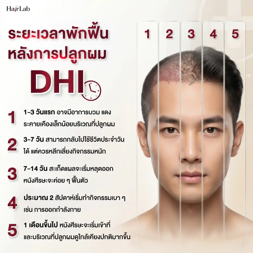 ระยะเวลาพักฟื้นหลังการปลูกผม DHI