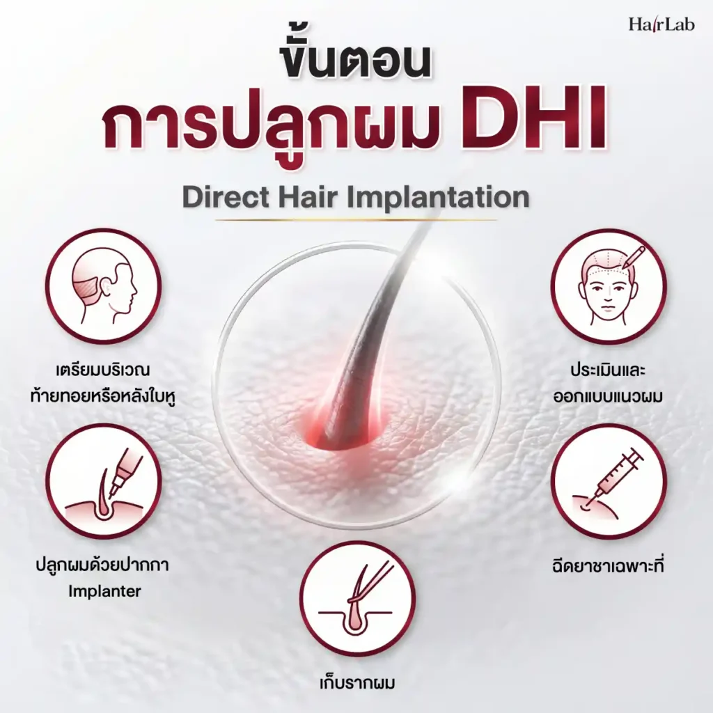 ขั้นตอนการปลูกผม DHI