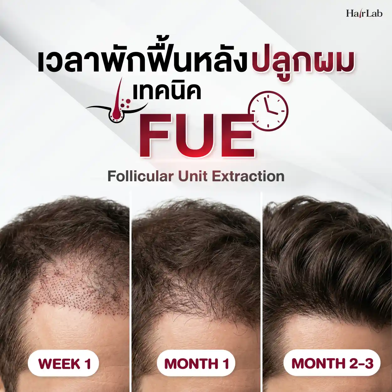 เวลาพักฟื้นหลังปลูกผมเทคนิค FUE