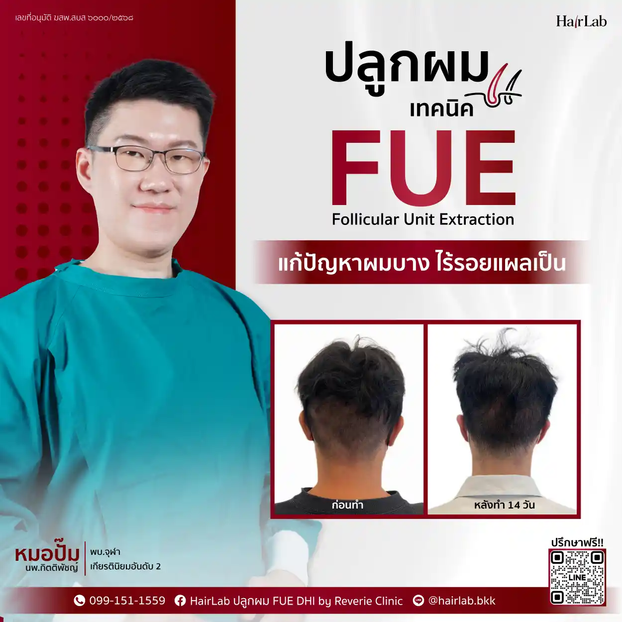 ปลูกผมเทคนิค FUE