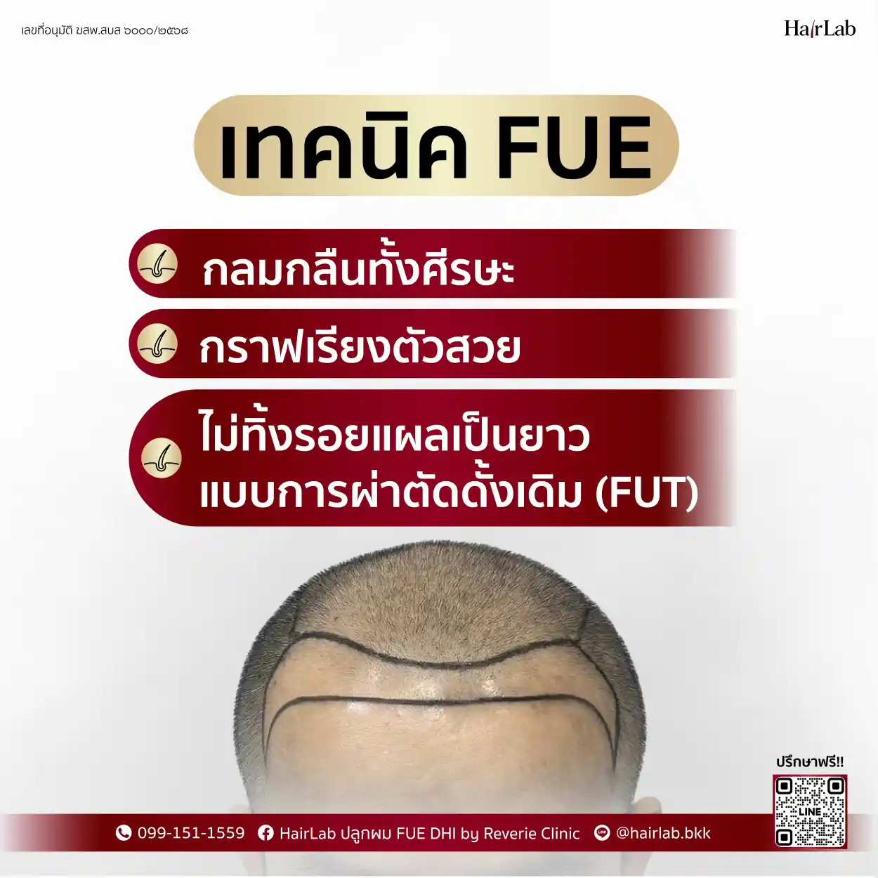 ข้อดีเทคนิค FUE