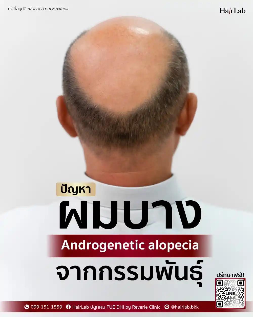 ปัญหาผมบางจากกรรมพันธุ์