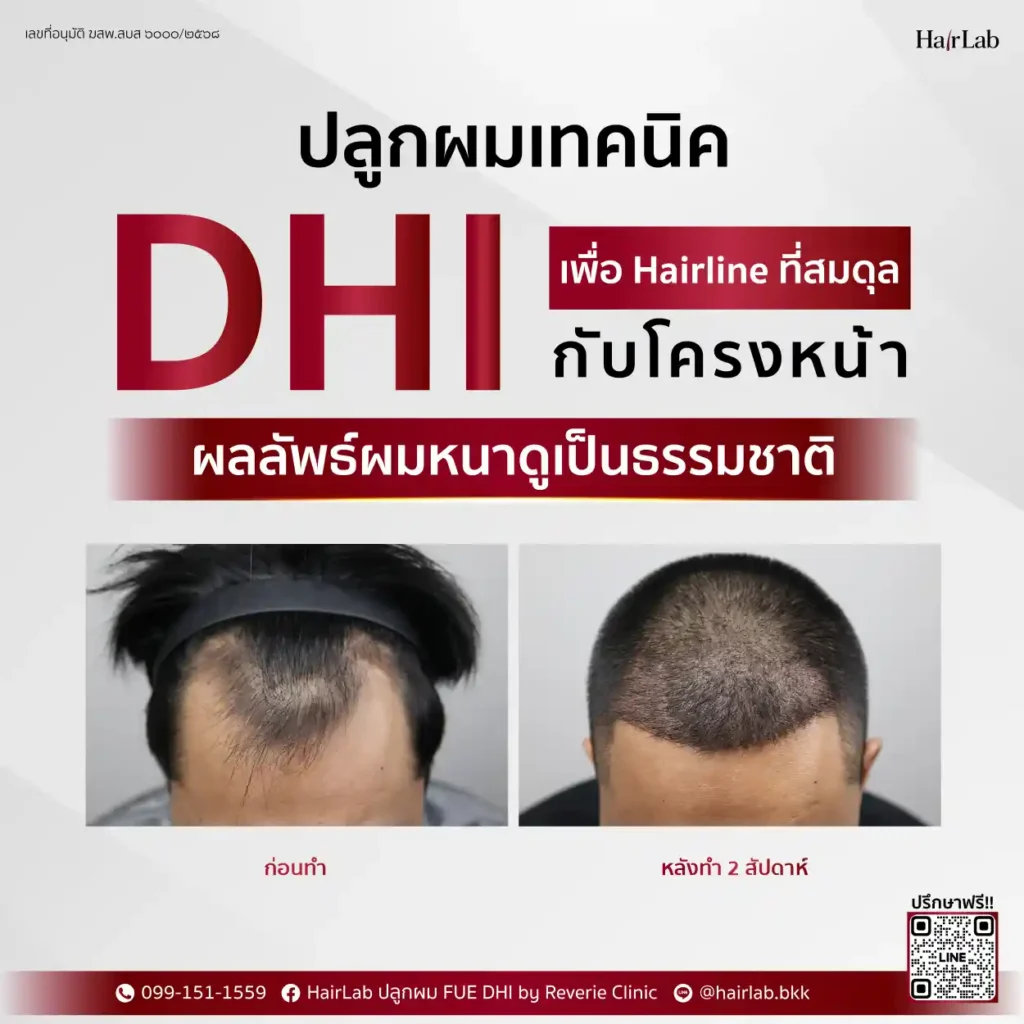 ปลูกผมเทคนิค DHI
