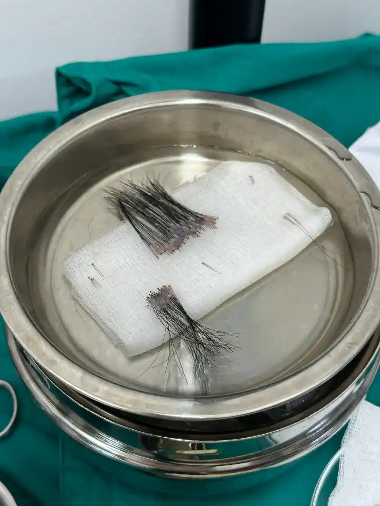 การคัดเลือกและดูแลกราฟผมอย่างทะนุถนอมเพื่ออัตราการรอดสูงสุด