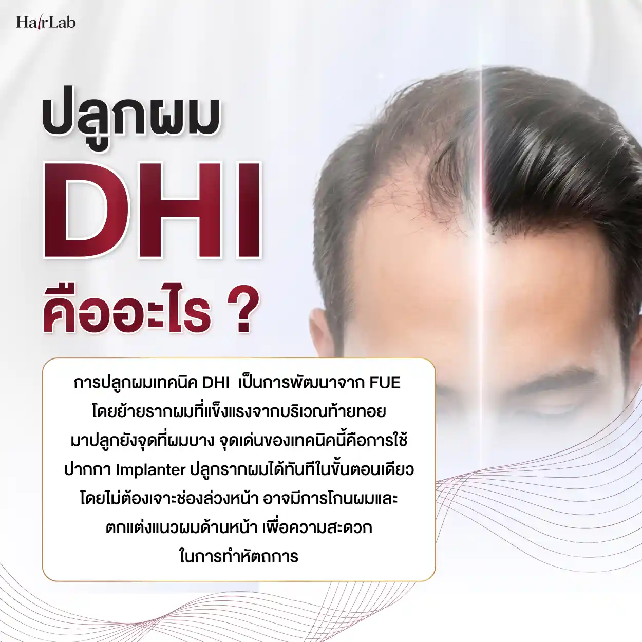 ปลูกผม DHI คืออะไร