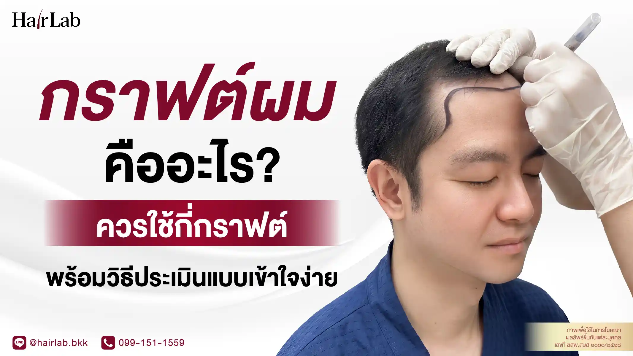 กราฟต์ผม คืออะไร ใช้กี่กราฟต์ถึงพอ พร้อมวิธีประเมิน