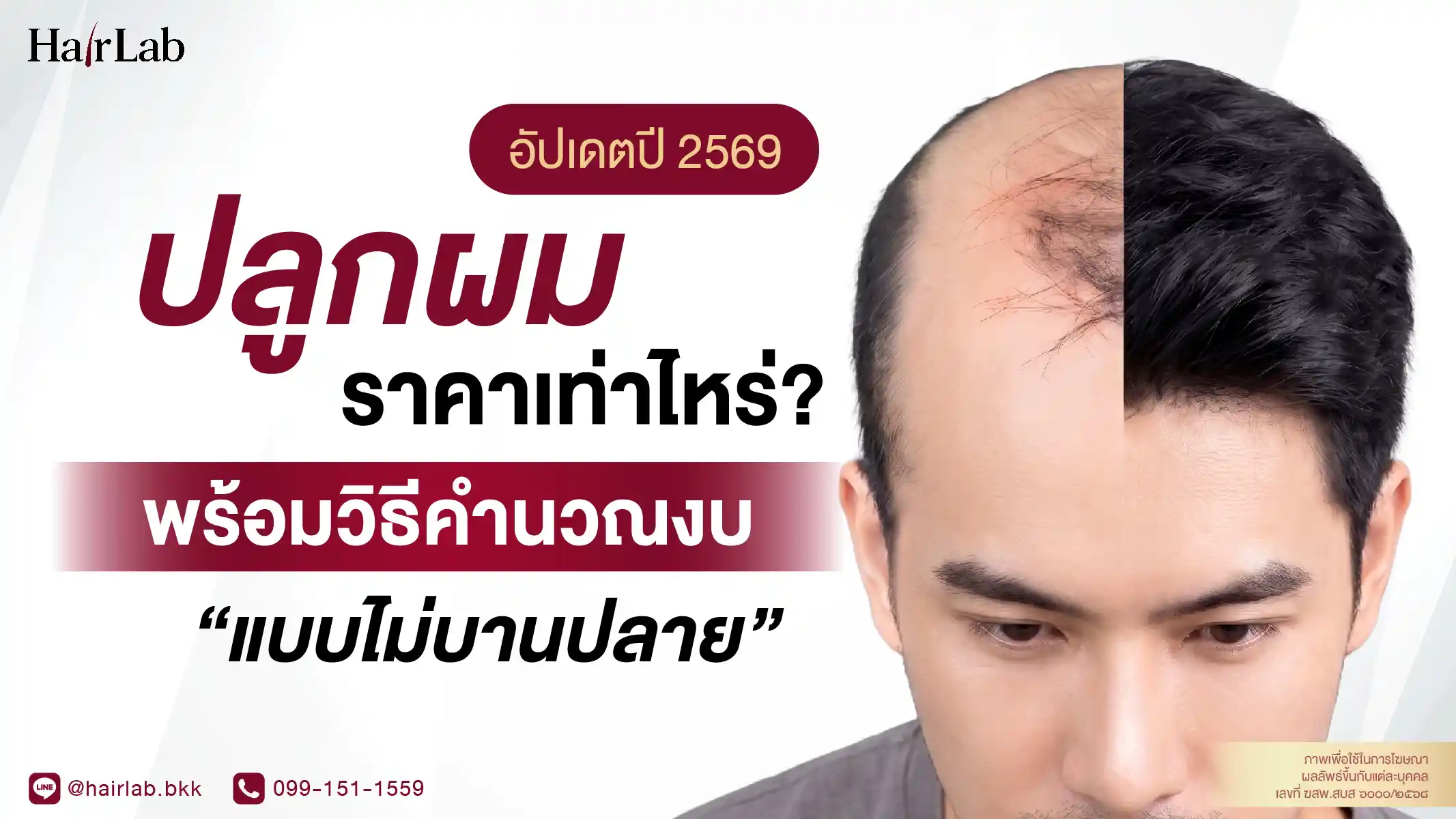 ปลูกผมราคาเท่าไหร่? อัปเดตปี 2569 พร้อมวิธีคำนวณงบแบบไม่บานปลาย