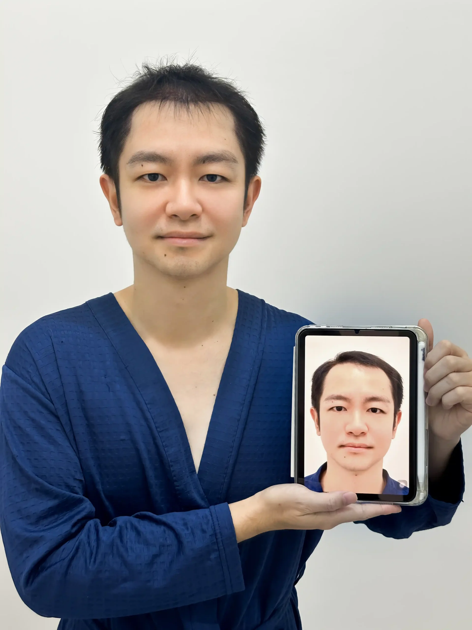 รีวิวผลลัพธ์การปลูกผมถาวรในผู้ชาย