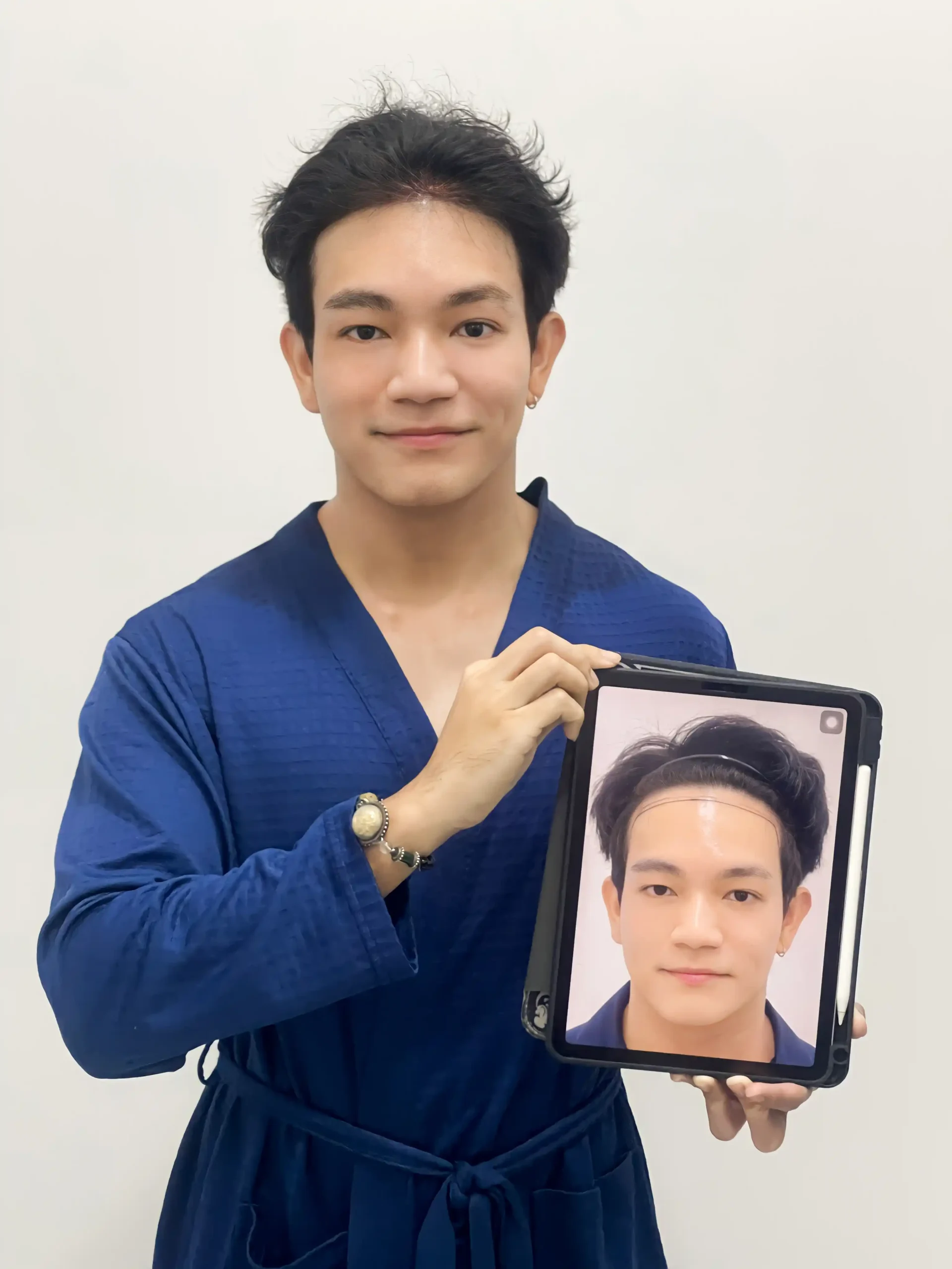 การวางแผนออกแบบแนวไรผมสำหรับผู้ชาย