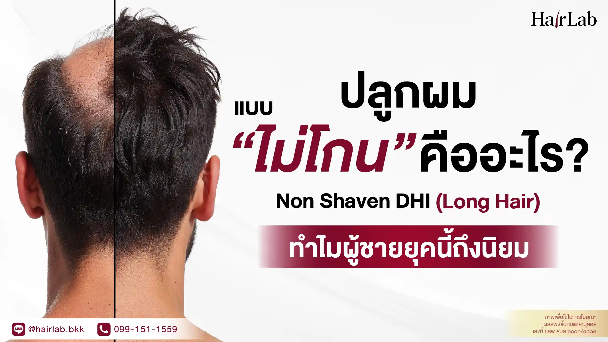 ปลูกผมไม่โกน Non Shaven DHI คืออะไร? ทำไมผู้ชายนิยม