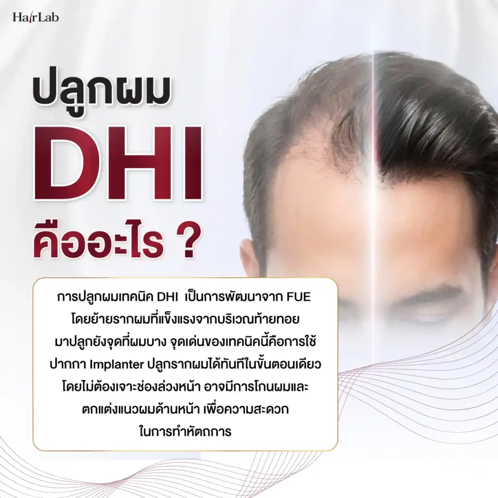 เทคนิคปลูกผม Non Shaven DHI คืออะไร?