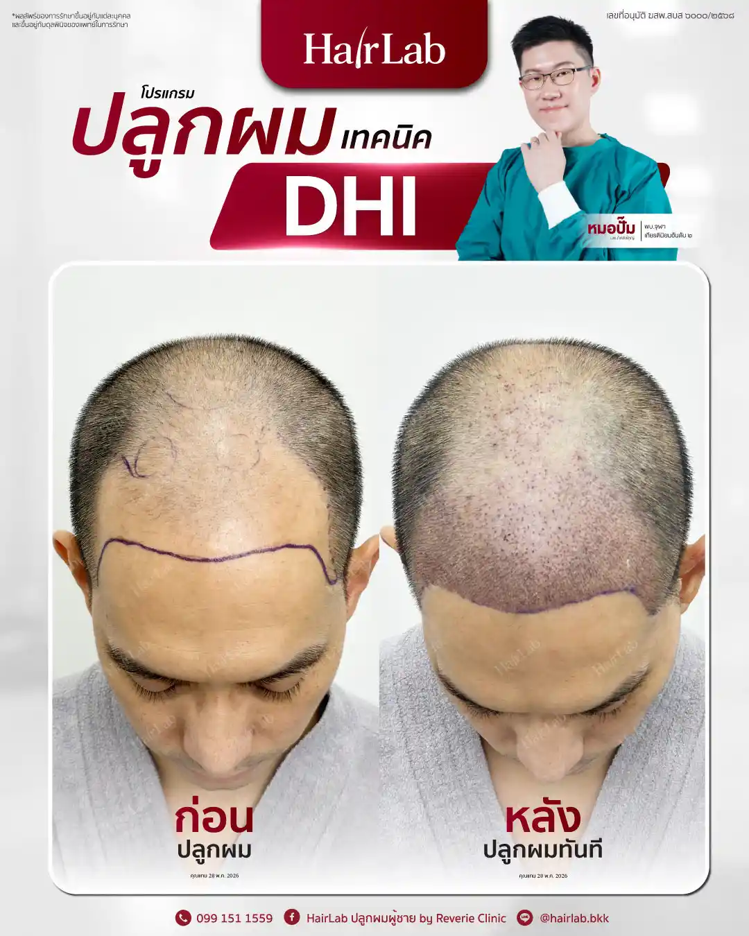 ก่อน-หลังปลูกผมเทคนิค DHI
