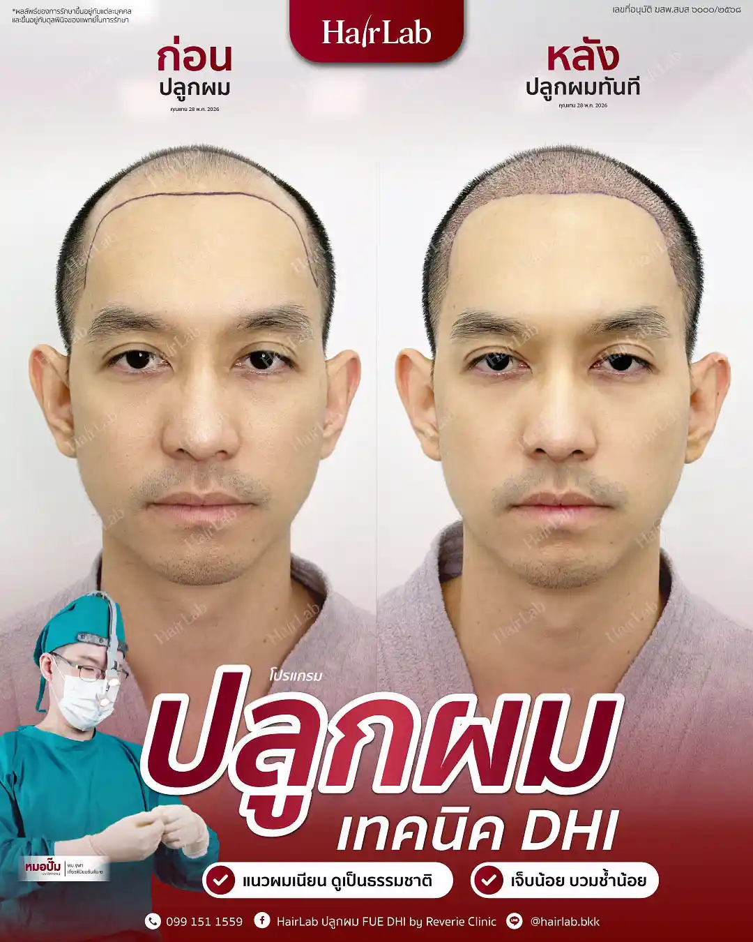 ก่อน-หลังปลูกผมเทคนิค DHI