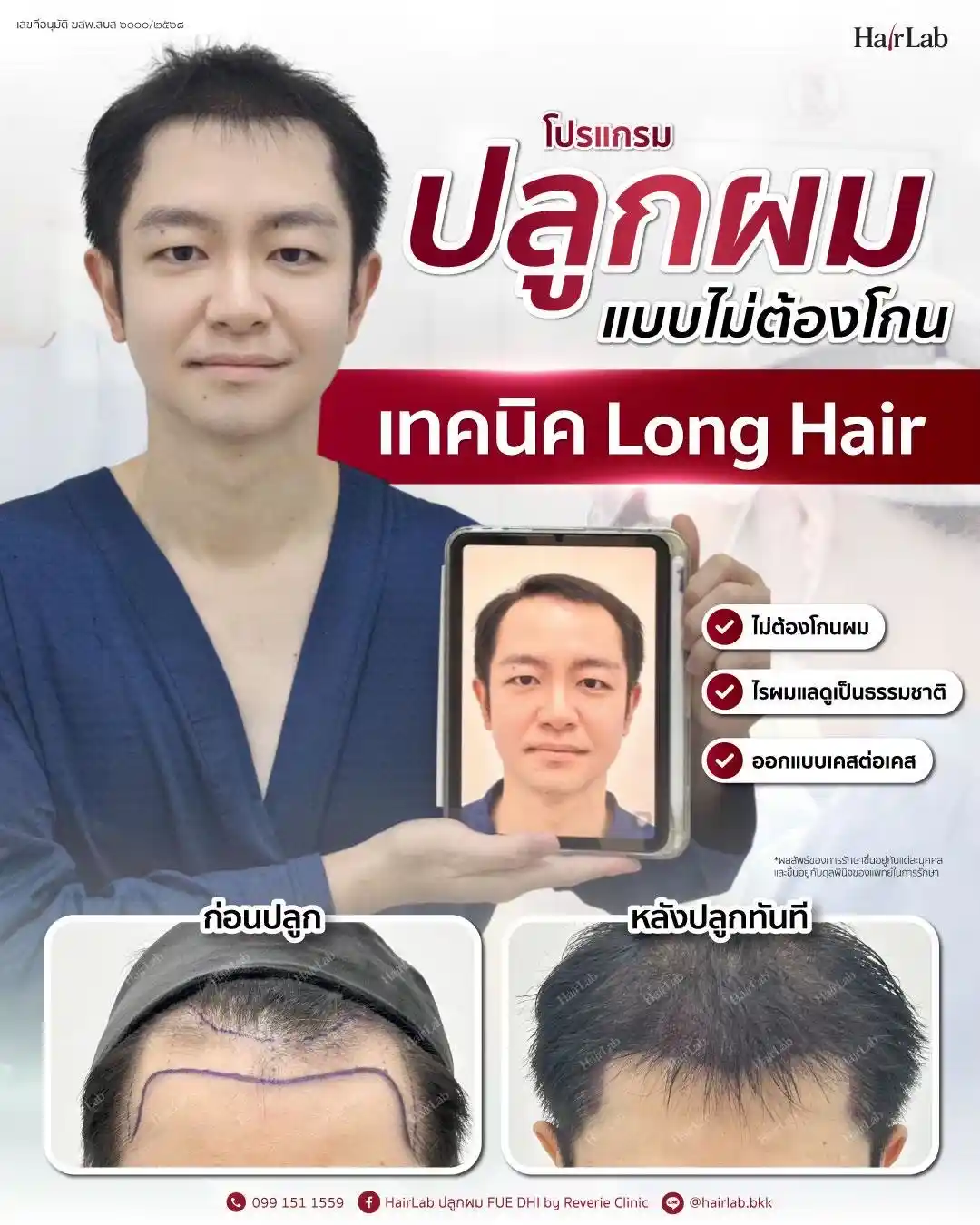 ก่อน-หลังปลูกผมเทคนิค Longhair