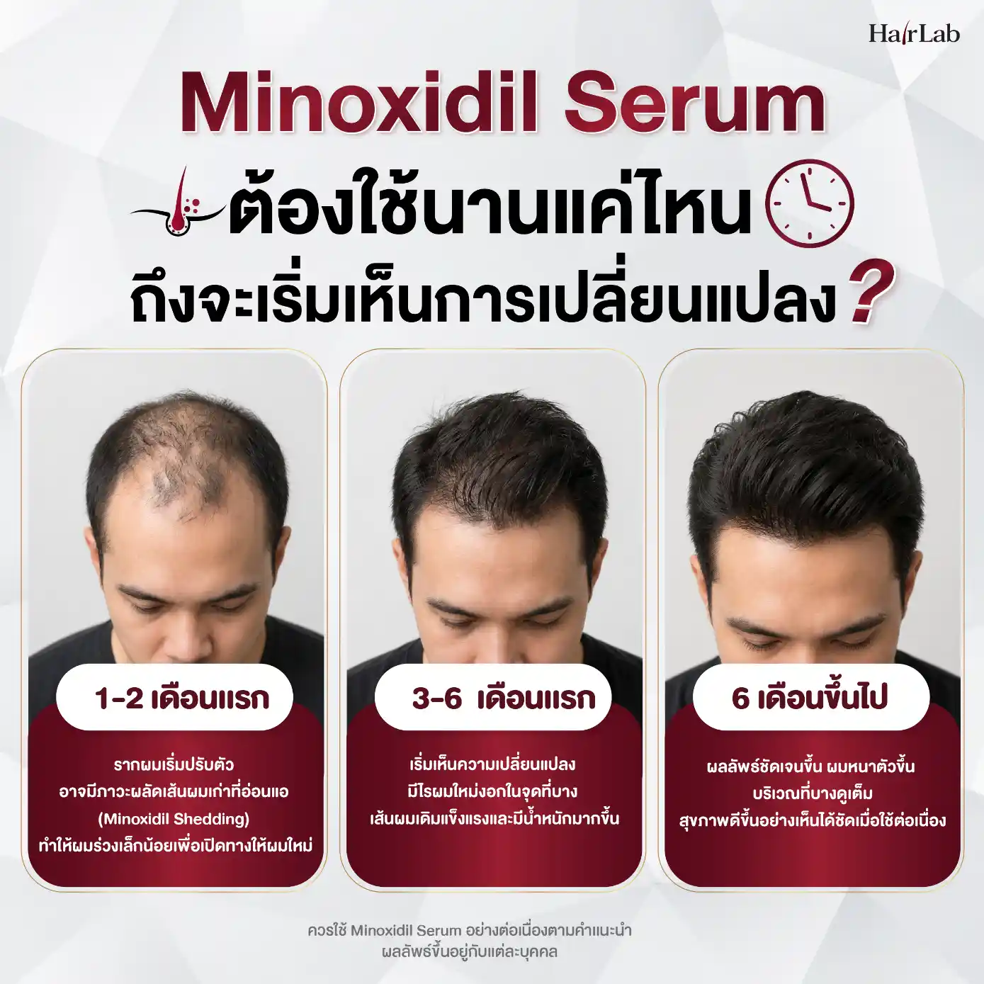 Minoxidil Serum ต้องใช้นานแค่ไหนถึงจะเริ่มเห็นการเปลี่ยนแปลง