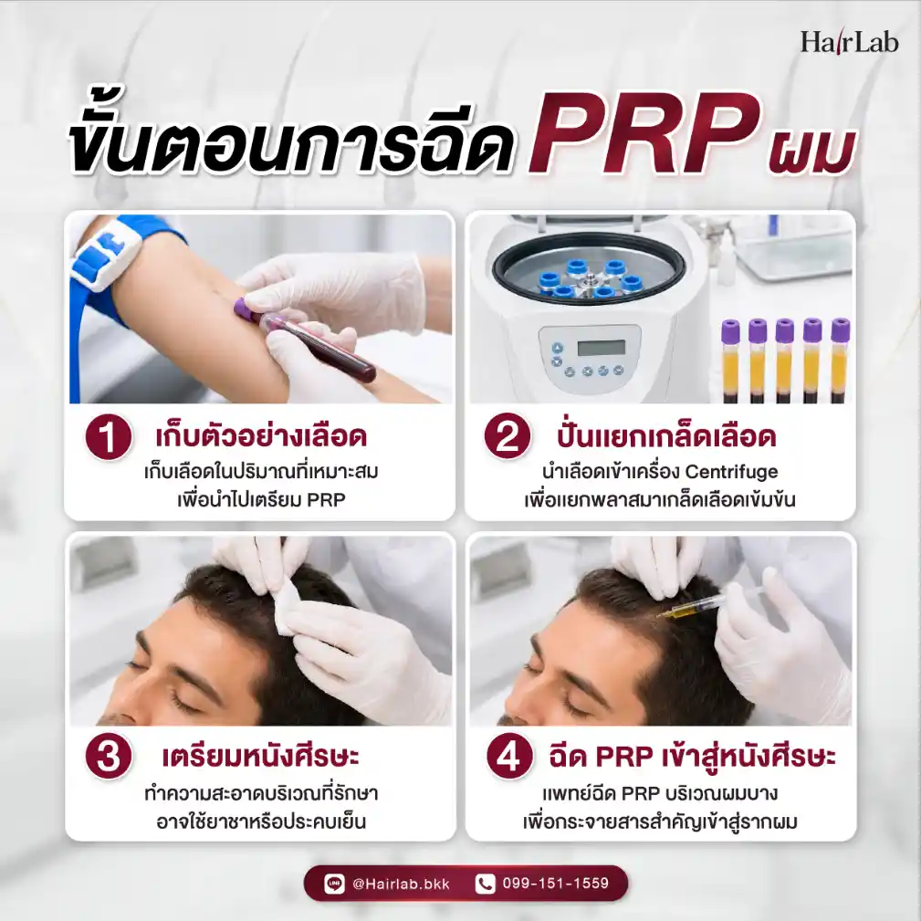 ขั้นตอนการฉีด PRP ผม