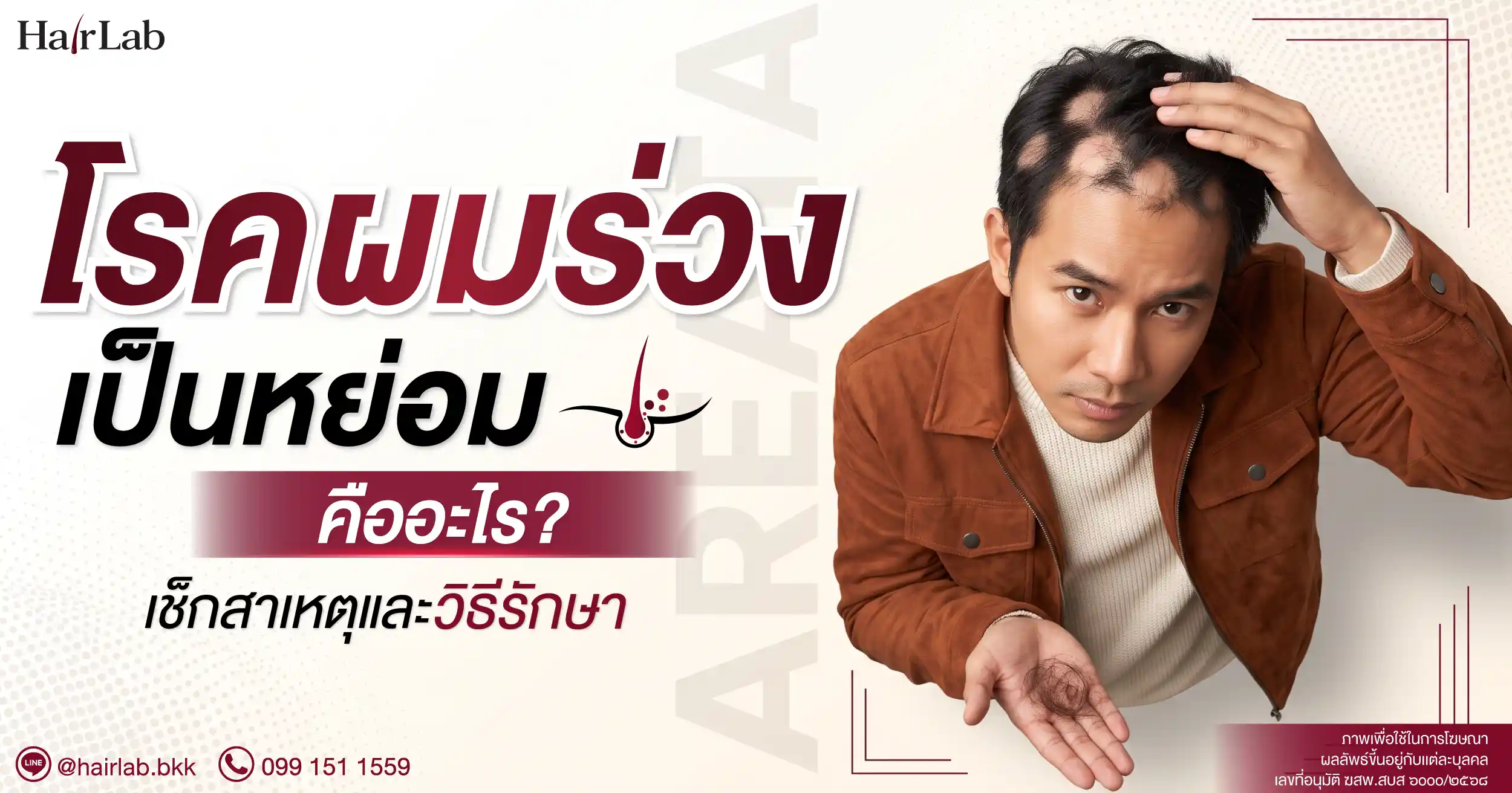 โรคผมร่วงเป็นหย่อม (Alopecia Areata) คืออะไร? เช็กสาเหตุและวิธีรักษา
