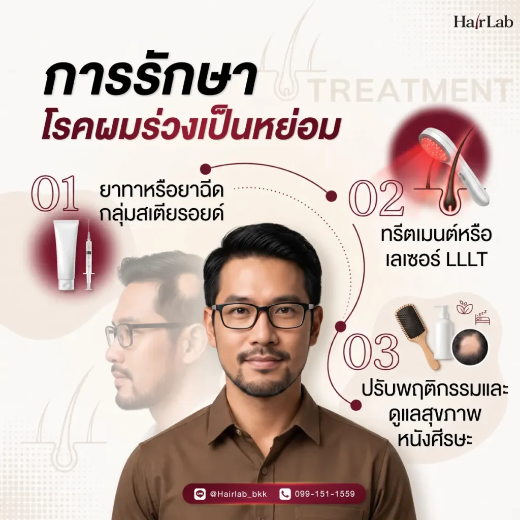 การรักษาโรคผมร่วงเป็นหย่อม