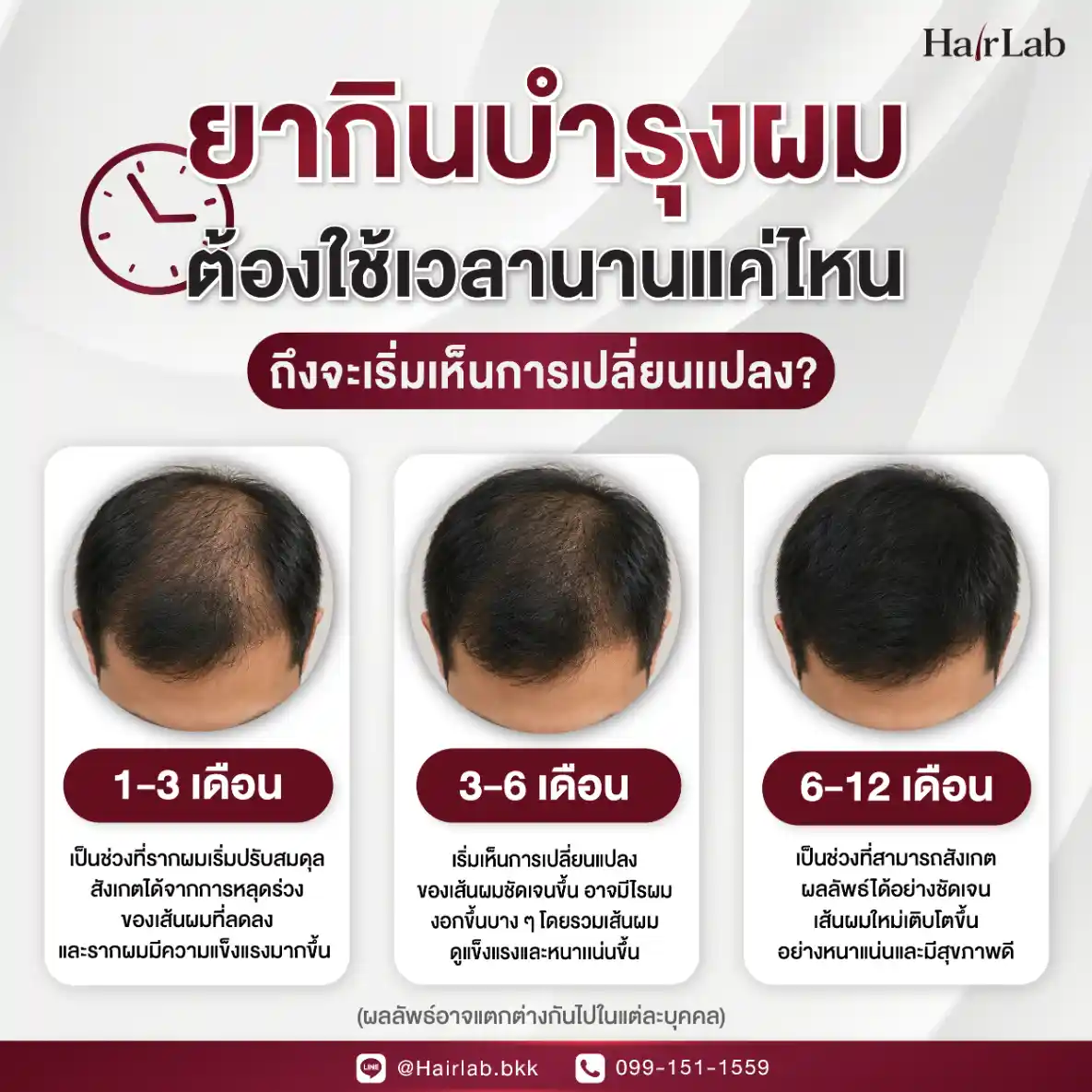 ยากินบำรุงผม ต้องใช้เวลานานแค่ไหนถึงจะเริ่มเห็นการเปลี่ยนแปลง