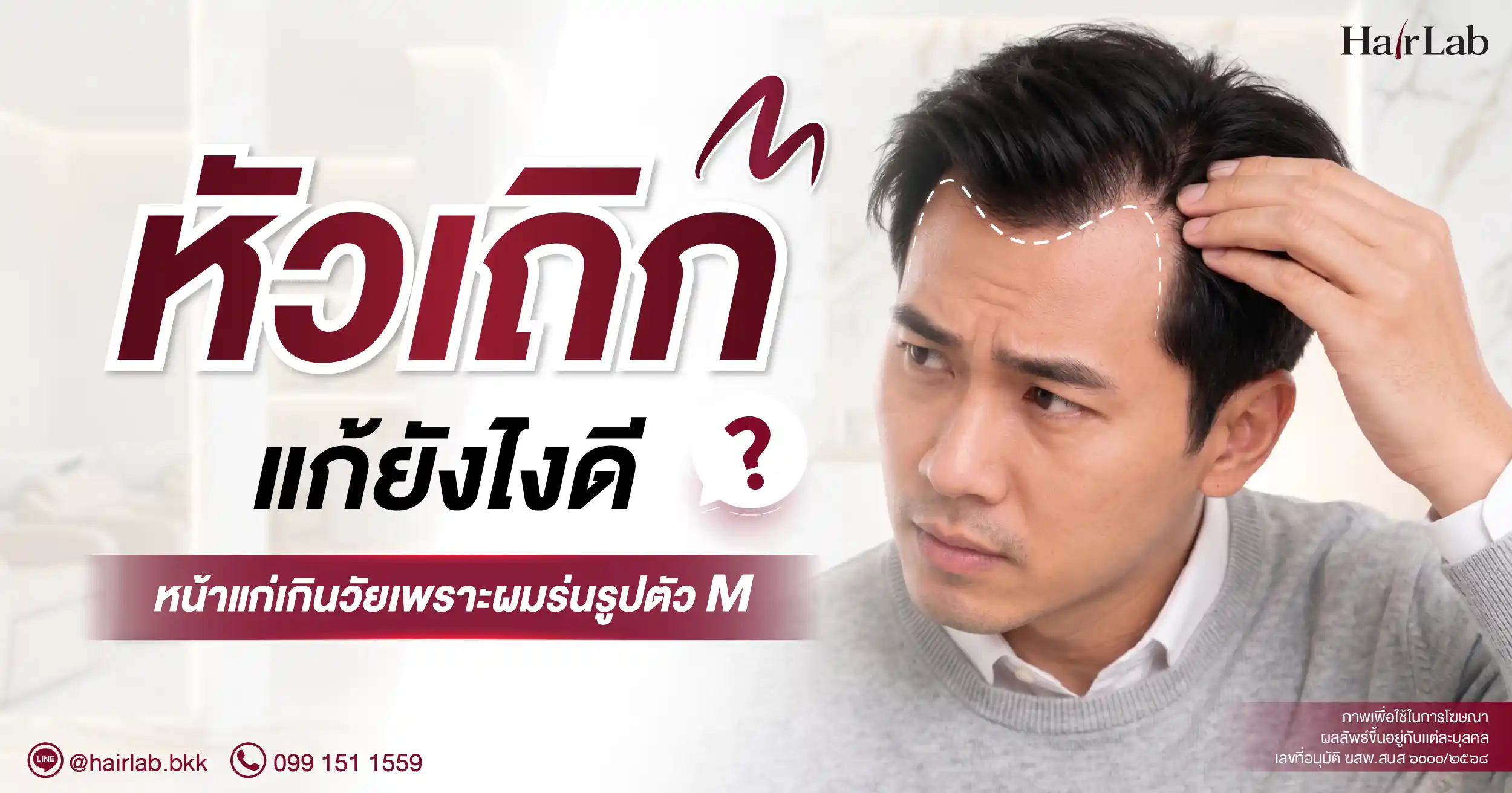 “หัวเถิก” แก้ยังไงดี? หน้าแก่เกินวัยเพราะผมร่นรูปตัว M